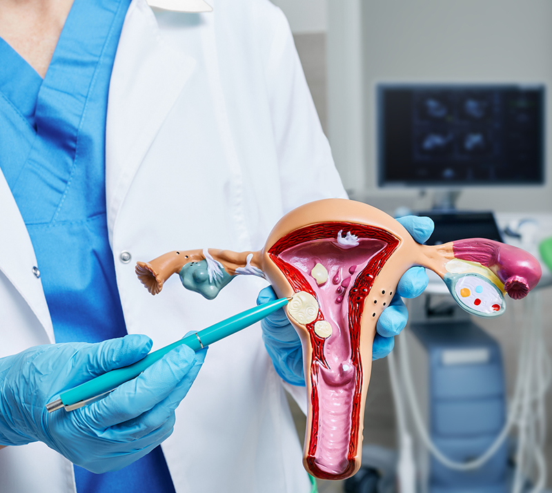 تشخیص فیبروم رحم با سونوگرافی واژینال؛ آیا همیشه نیاز به جراحی است؟